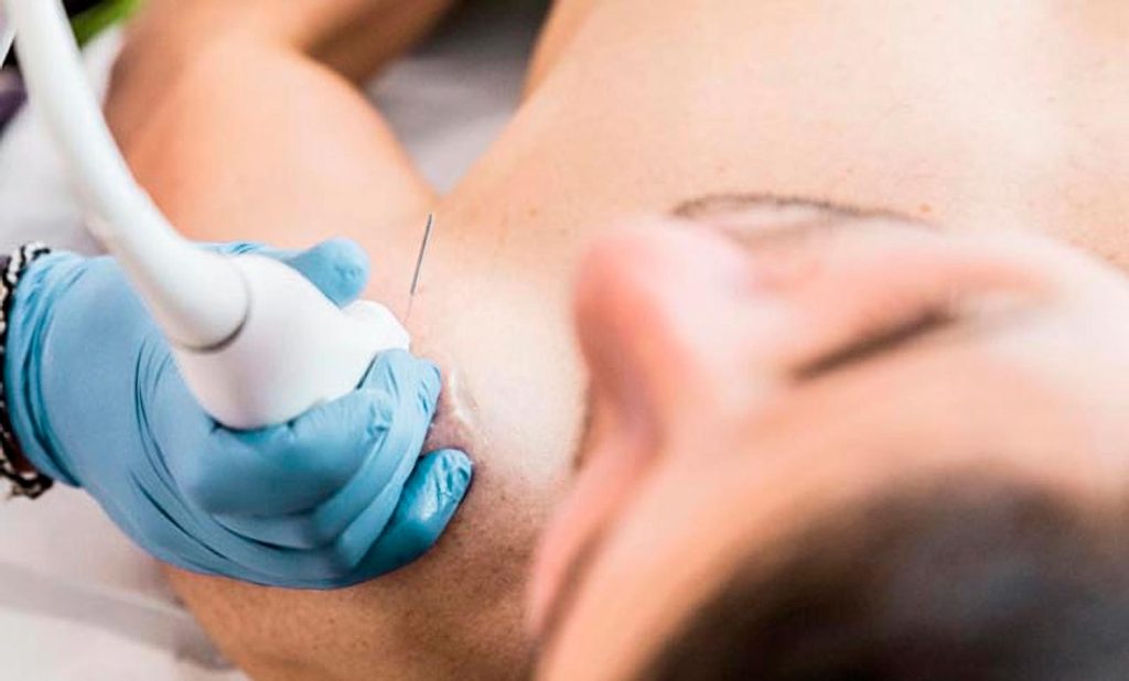 Punción seca fisioterapia