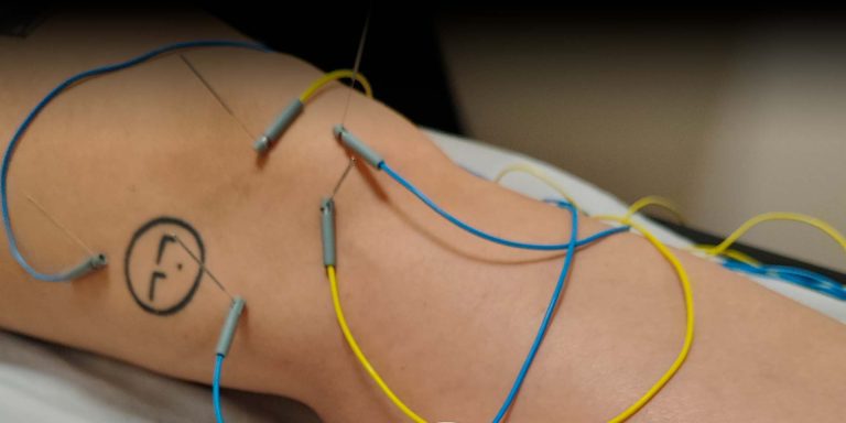 Fisioterapia invasiva en Madrid